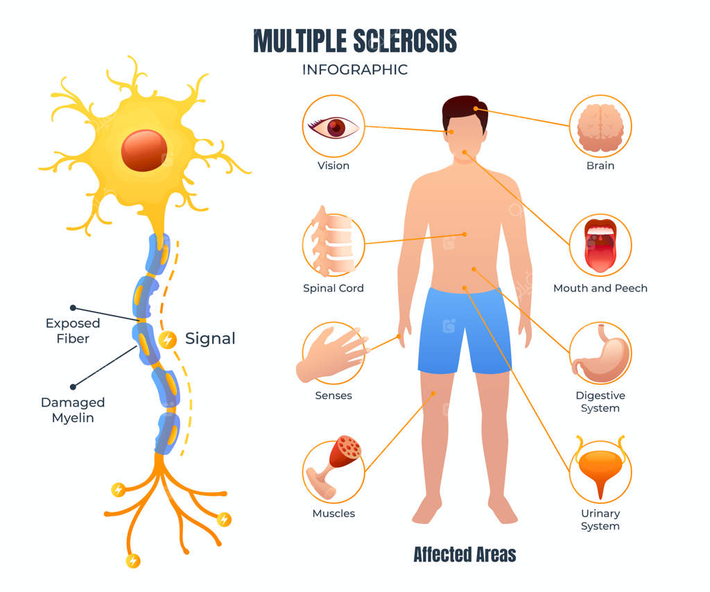اینفوگرافی طراحی دستی و تخت در مورد ام‌اس (Multiple Sclerosis)