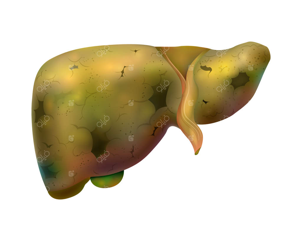 ترکیب واقع‌گرایانه اندام‌های داخلی انسان با تصویر جداگانه از کبد آسیب‌دیده روی پس‌زمینه خالی، تصویر برداری.