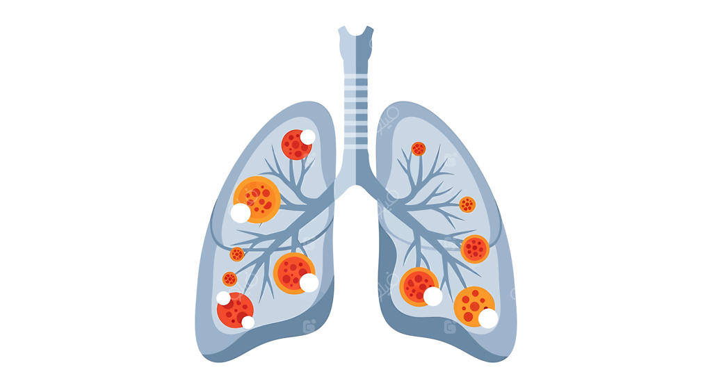 تصویری مفهومی از ریه‌های انسان با ضایعات داخلی یا سلول‌های بدخیم - برجسته‌سازی مشکلات سلامتی و بیماری‌های تنفسی