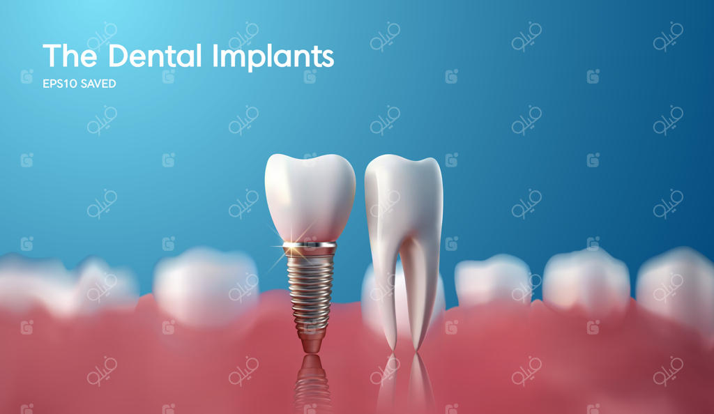 ایمپلنت دندان سفید: انتخاب ایمپلنت، دندان سالم یا جراحی دندانپزشکی؟