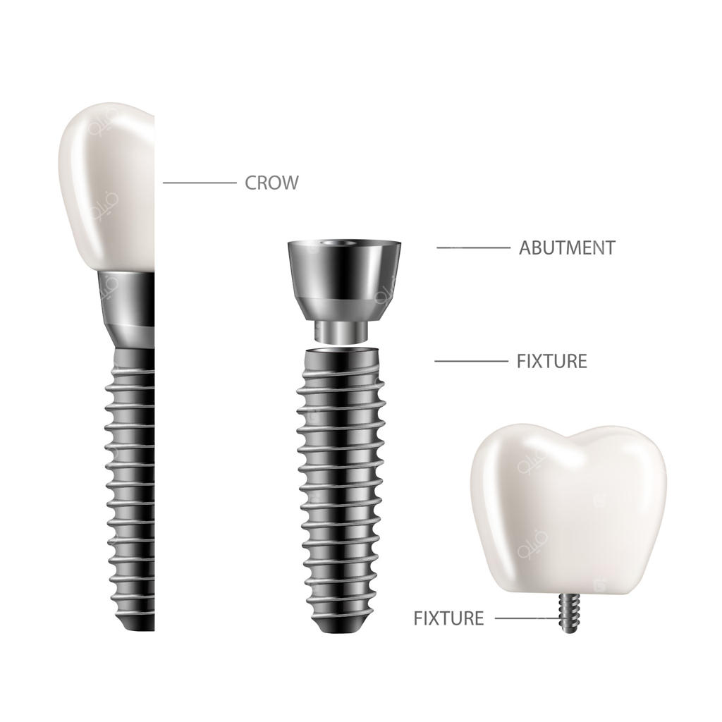 ایمپلنت دندان