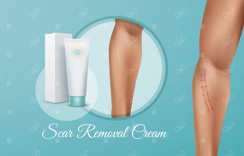 تبلیغ کرم رفع اسکار: مقایسه زخم تازه و بهبود یافته روی دست مرد پس از عمل جراحی