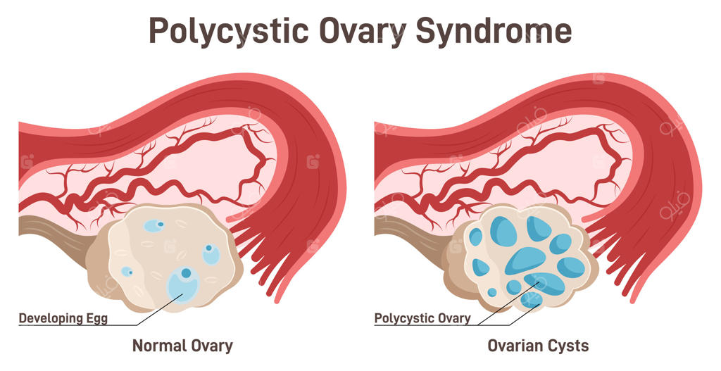 سندرم تخمدان پلی‌کیستیک (PCOS)؛ بیماری هورمونی و دستگاه تولید مثل زنان