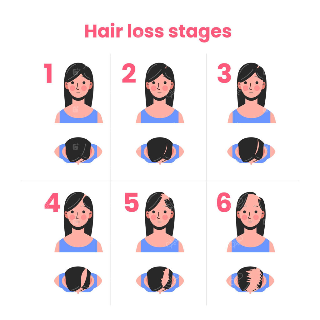 مراحل ریزش مو در زنان به صورت دستی و مسطح کشیده شده