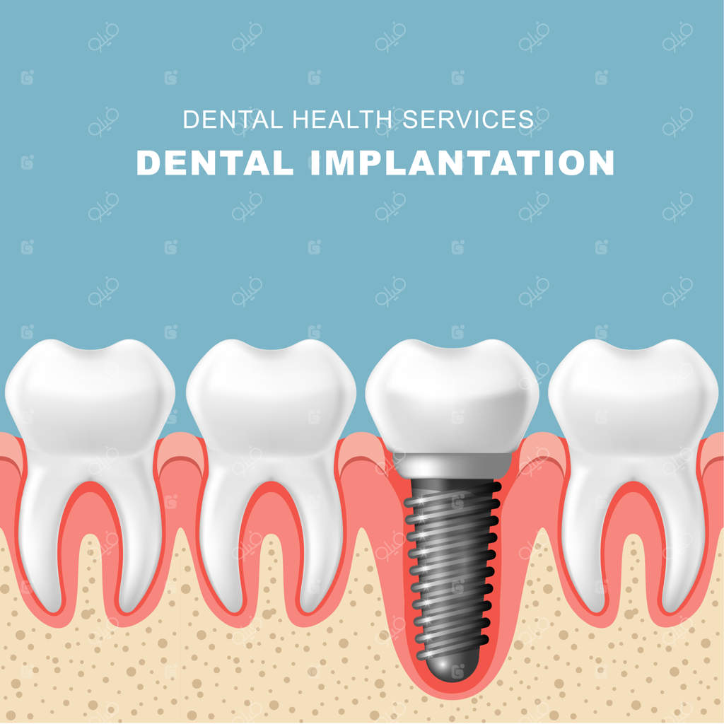 ایمپلنت دندانی - قرار دادن دندان‌ها در لثه با استفاده از ایمپلنت
