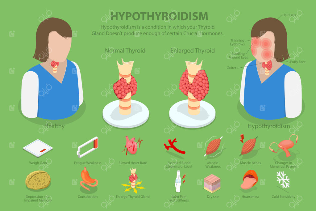 تصویر مفهومی ایزومتریک سه‌بعدی از کم‌کاری تیروئید، بیماری غده تیروئید