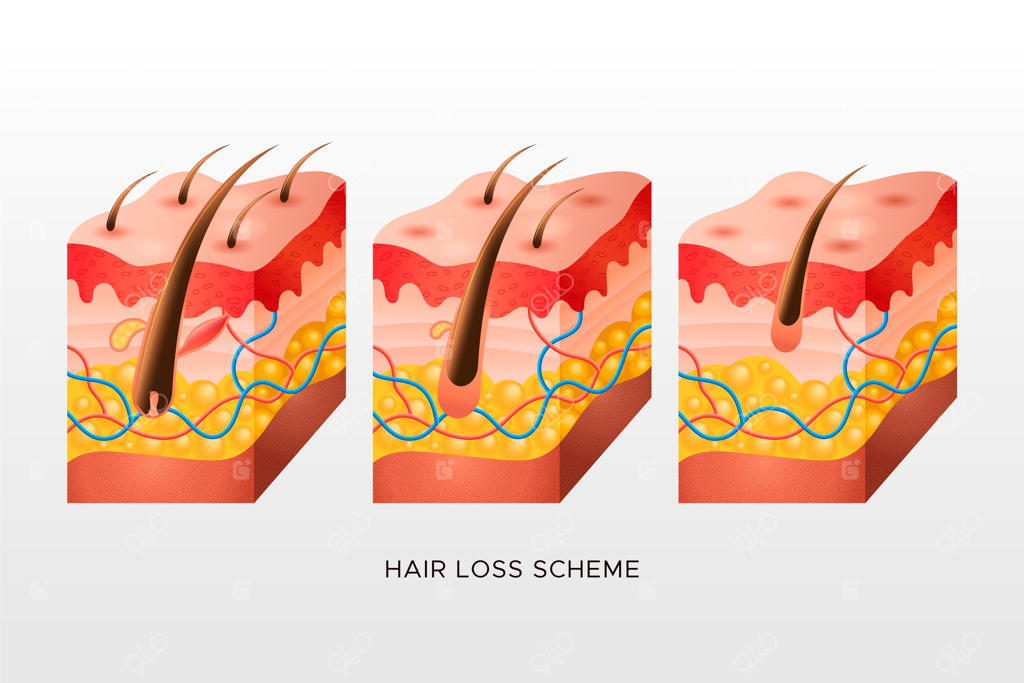 طرح ریزش مو به روش تدریجی