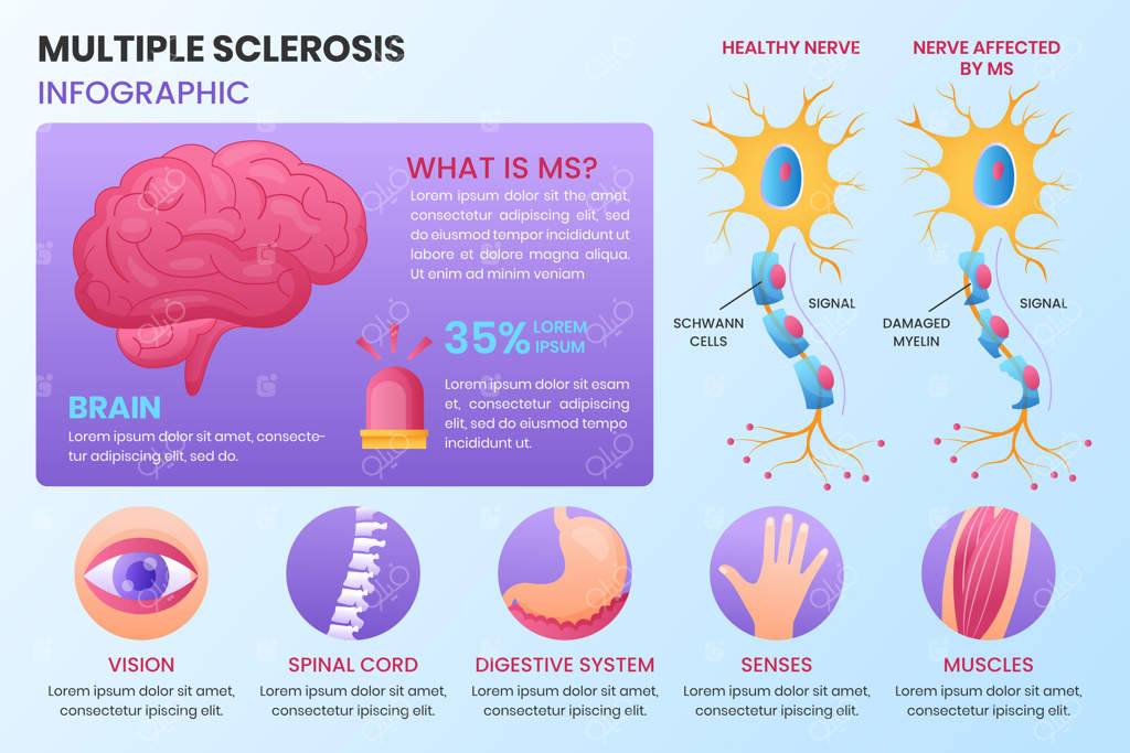 اینفوگرافی طیف‌های مختلف ام‌اس