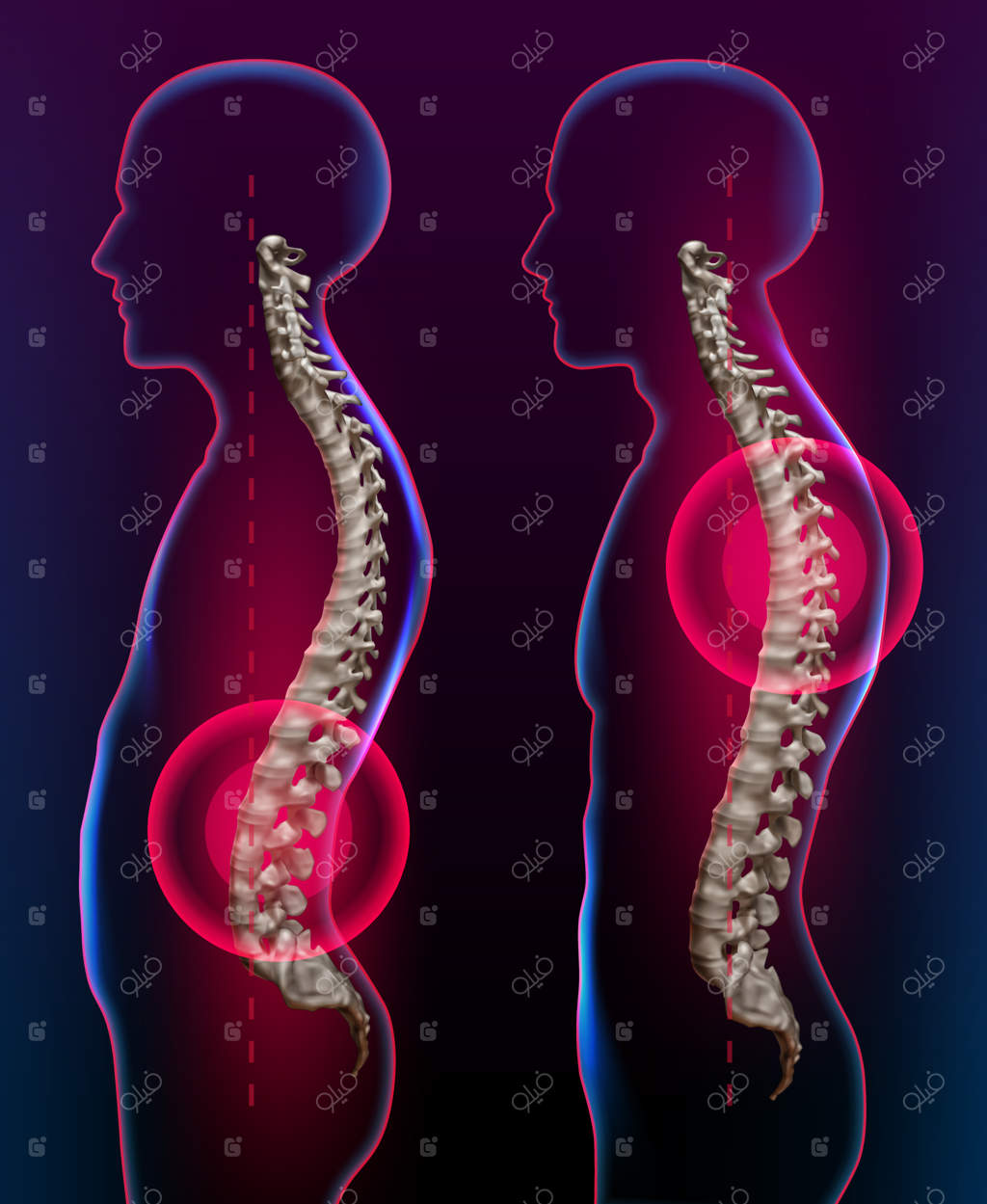 تصویری از کمردرد به عنوان مفهوم مراقبت‌های پزشکی برای سلامت ستون فقرات و درمان آن