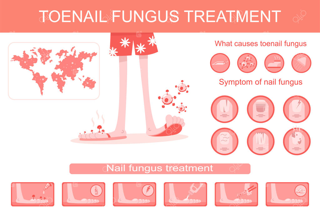 اینفوگرافیک درمان قارچ ناخن پا: تصاویر کارتونی از عفونت، علائم و روش‌های درمان و پیشگیری از بیماری.