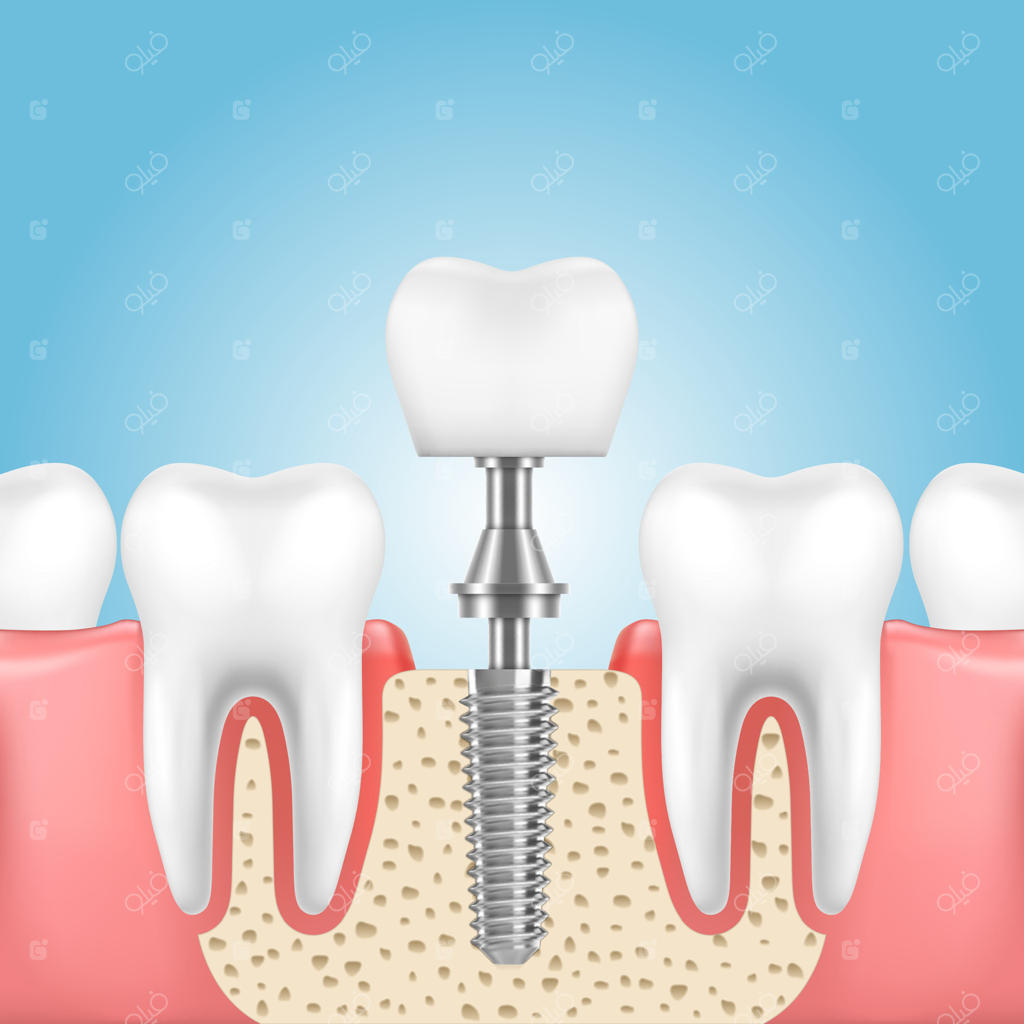 ایمپلنت دندانی و فناوری دندانپزشکی جهت پروتز دندانی