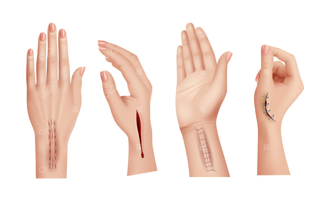 بخیه‌های جراحی روی دست‌ها: نمای نزدیک از زخم‌ها و جای زخم در پوست آسیب‌دیده انسان - قالب‌های واقع‌گرایانه وکتور مرتب. عملیات جراحی و تصویرسازی بخیه جراحان