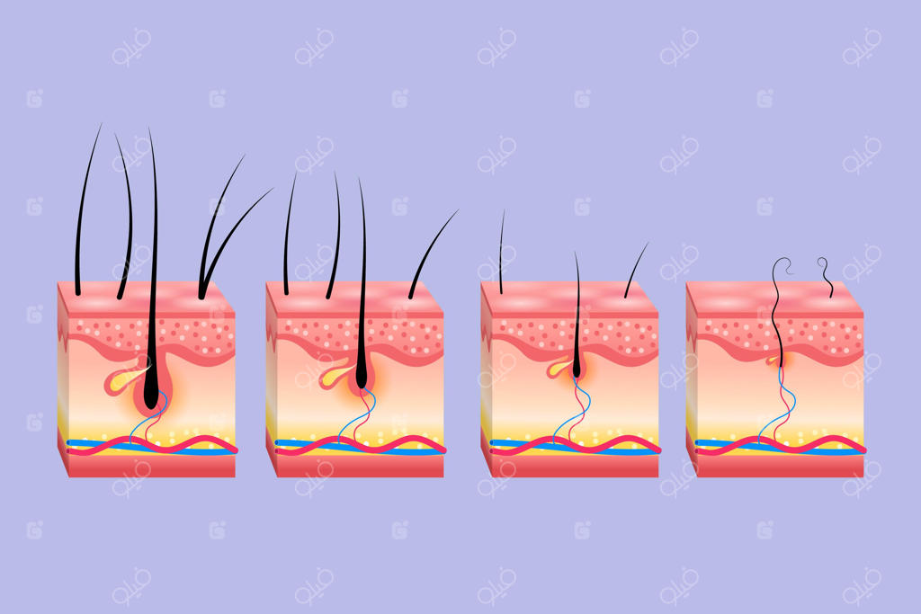 طرح ریزش تدریجی مو