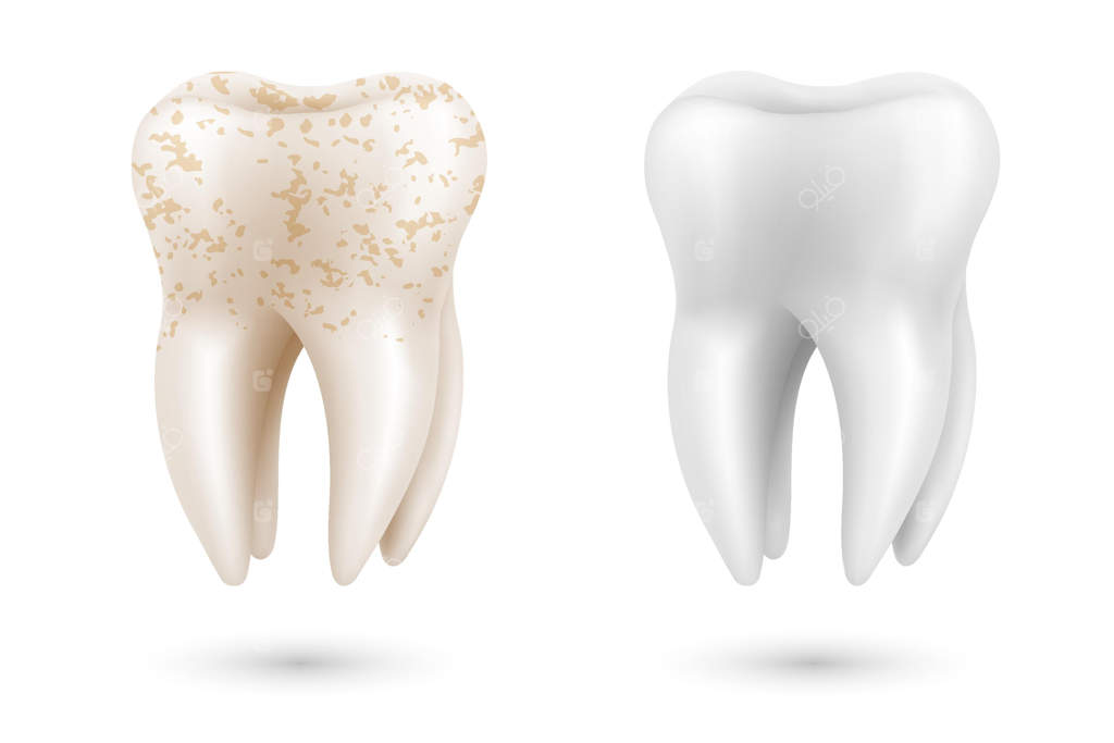 مفهوم سه‌بعدی سفیدکردن دندان: مقایسه دندان تمیز و کثیف قبل و بعد از سفیدکردن - طرح پوستر سلامت دهان و دندان برای طراحی در دندان‌پزشکی - وکتور واقع‌گرایانه
