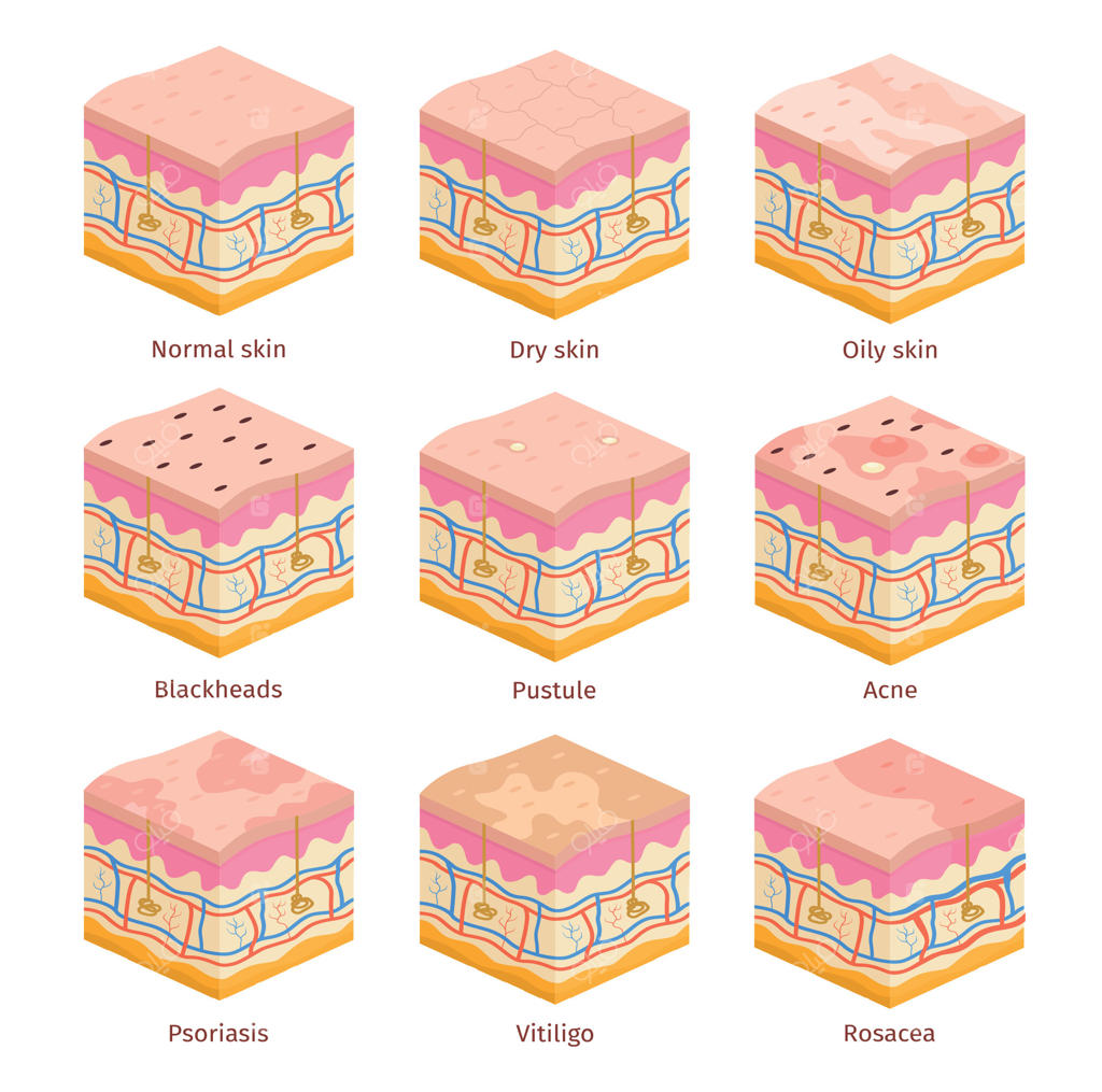 برش مقطعی سه‌بعدی از لایه‌های پوست انسان: اپیدرم خشک، چرب و نرمال. مجموعه وکتور مشکلات پوستی شامل آکنه، جوش‌های سرسیاه، پسوریازیس و ویتیلیگو