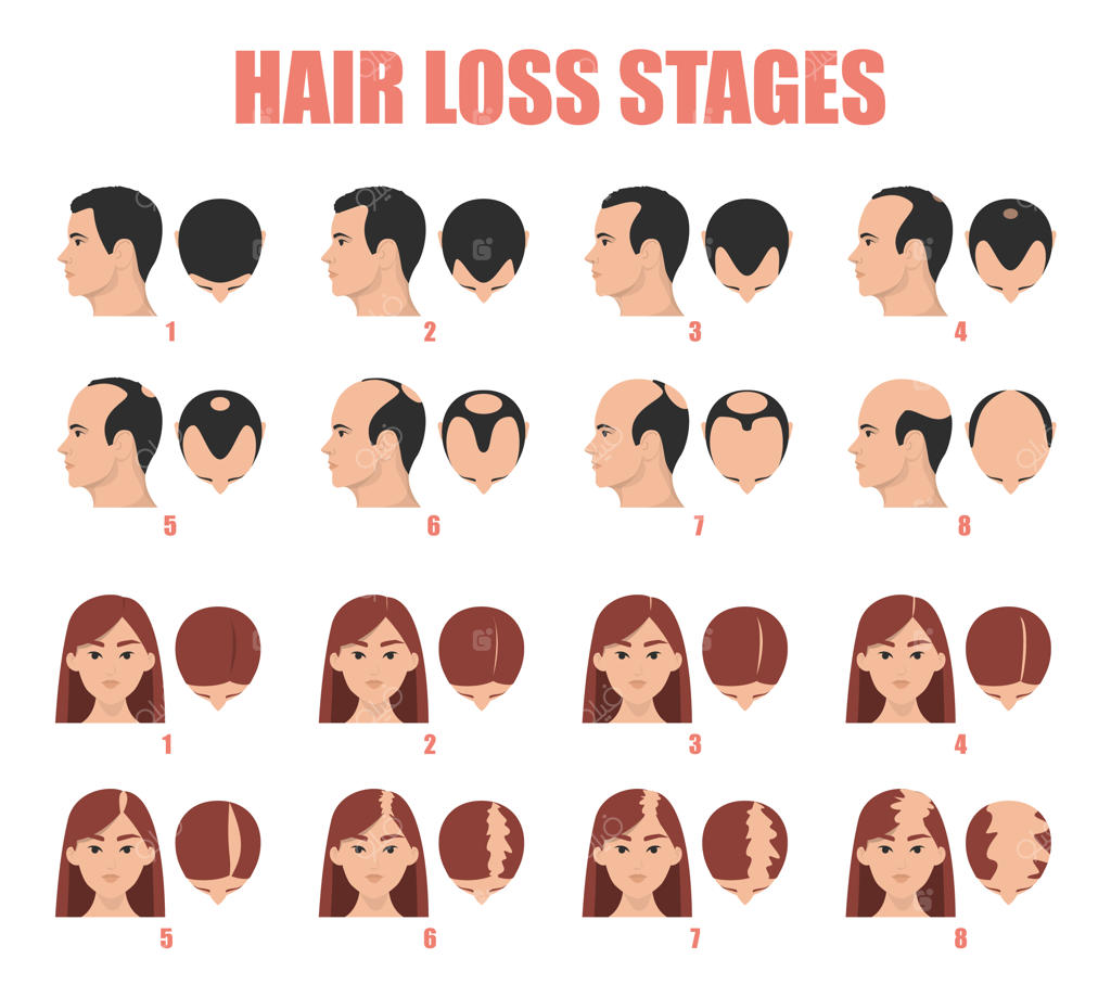 مراحل ریزش مو و طاسی در زنان و مردان