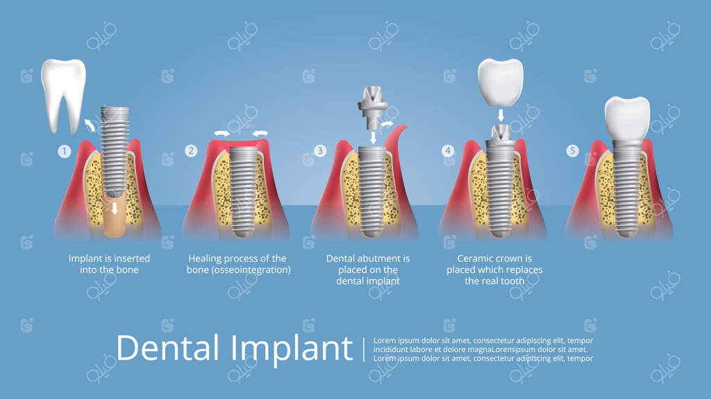 تصویر برداری از دندان‌ انسان و ایمپلنت‌های دندانی