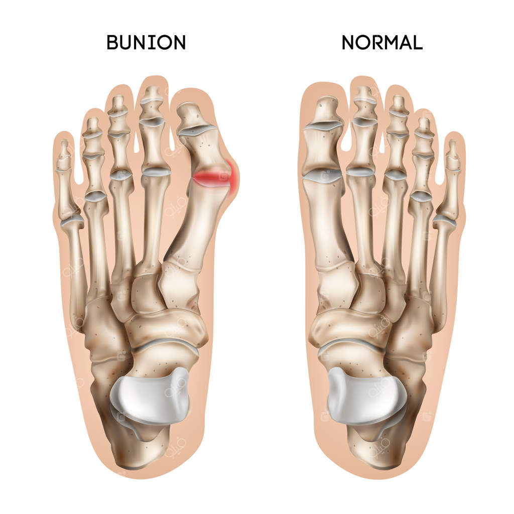 ترکیب واقعی انحراف انگشت پا با نمایی از گام‌های عادی و آسیب‌دیده انسانی