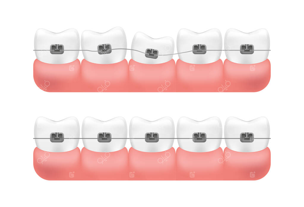 اصلاح موقعیت دندان‌ها با ارتودنسی