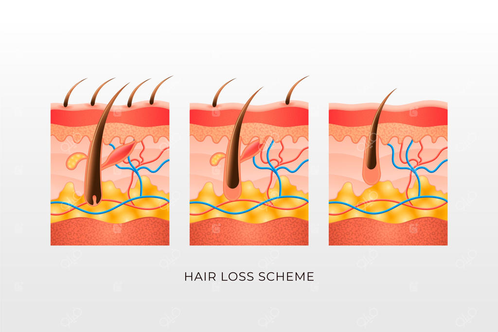 طرح ریزش مو به سبک گرادیان
