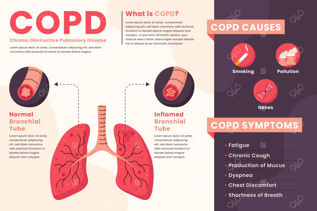 قالب اینفوگرافیک بیماری COPD با طراحی فلت و دستی