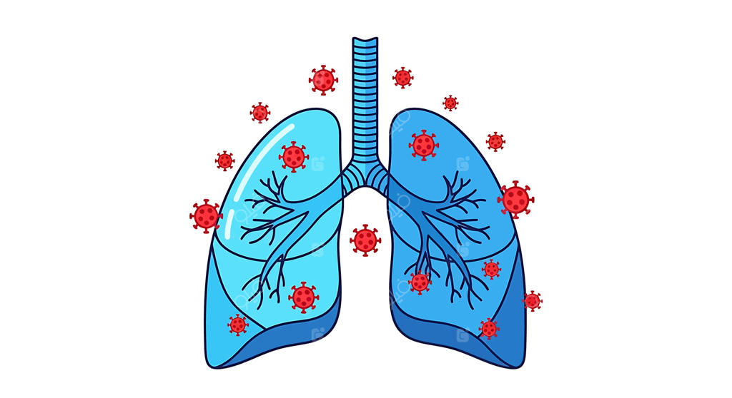 تصویرسازی پزشکی از حمله ویروس به سیستم تنفسی انسان، هنر مفهومی از عفونت و بیماری ریه